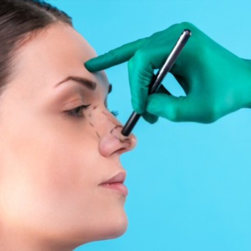 Rhinoplastie de révision en Tunisie : corriger et sublimer votre nez