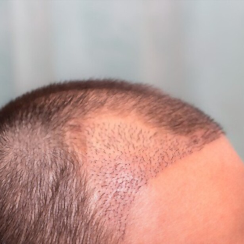Les 10 Choses À Éviter Après Une Greffe De Cheveux