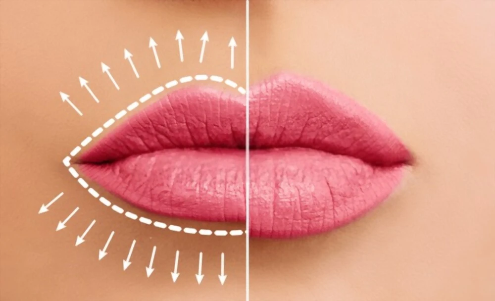 4 Raisons De Recourir Au Lip Filler Même Si Vous Ne Voulez Pas De Grosses Lèvres