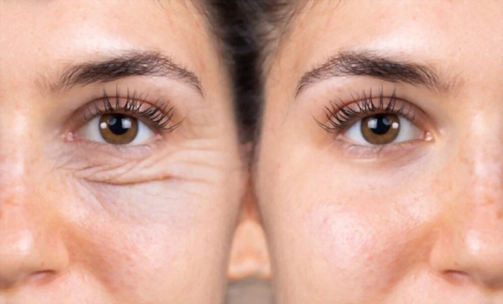 Blépharoplastie en Tunisie - Chirurgie des paupières pour un regard rajeuni