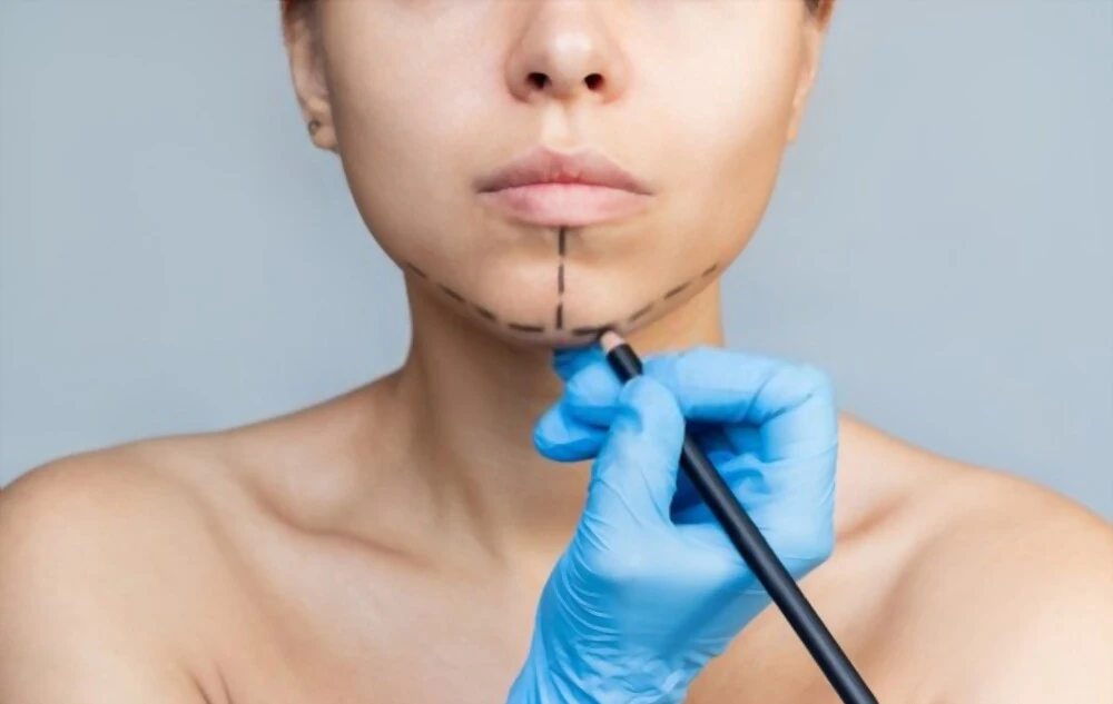 Genioplastie en Tunisie - Correction du menton pour un visage harmonieux