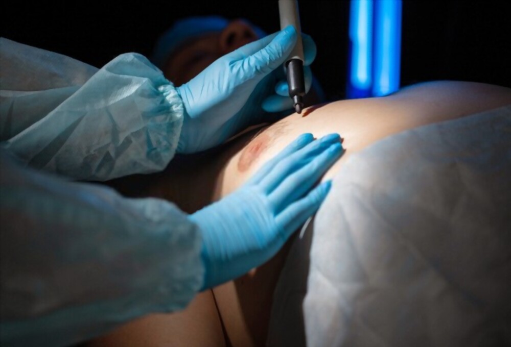 Gynécomastie Tunisie – chirurgie de réduction mammaire masculine Medica Tour