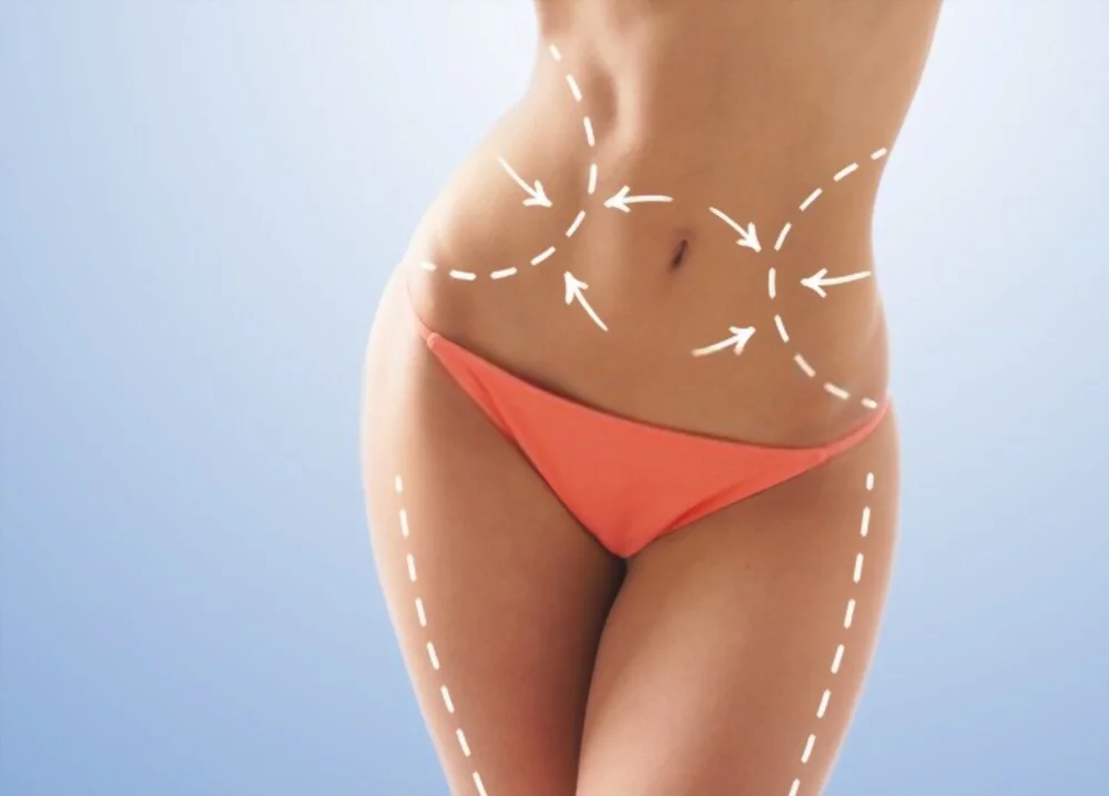 Liposuccion après grossesse : remodeler sa silhouette en toute sécurité