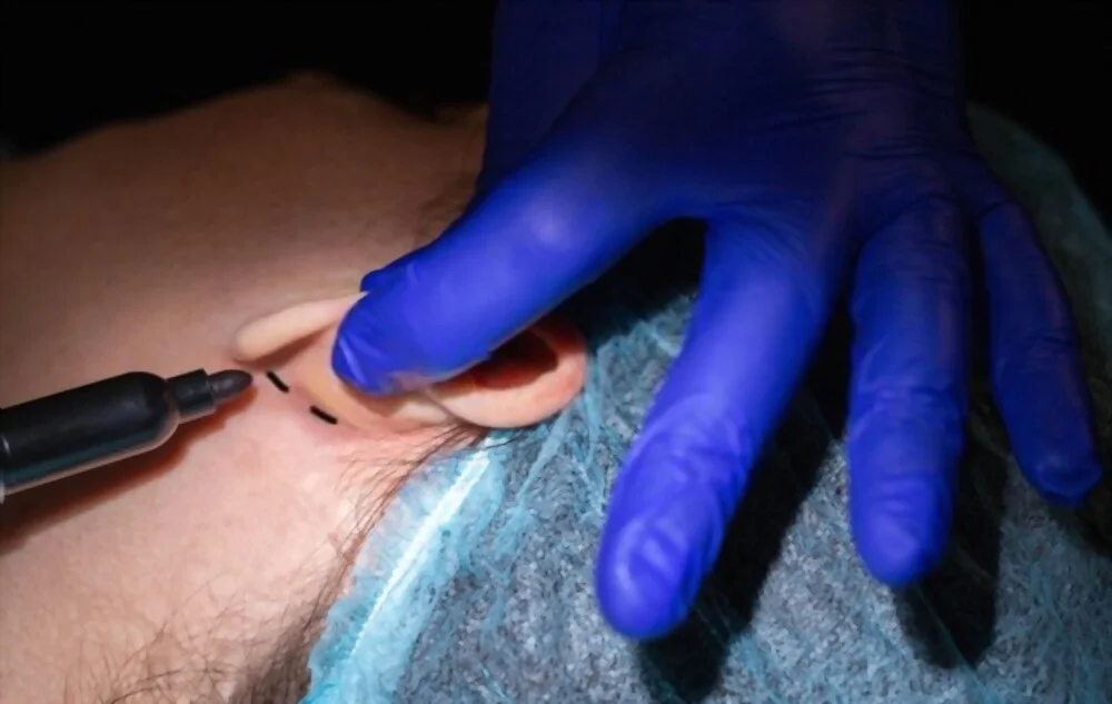 Otoplastie : Vous envisagez une chirurgie de l’oreille, voici ce que vous devez savoir