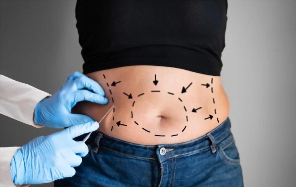 Prix abdominoplastie Tunisie : Remodeler son ventre à un tarif abordable