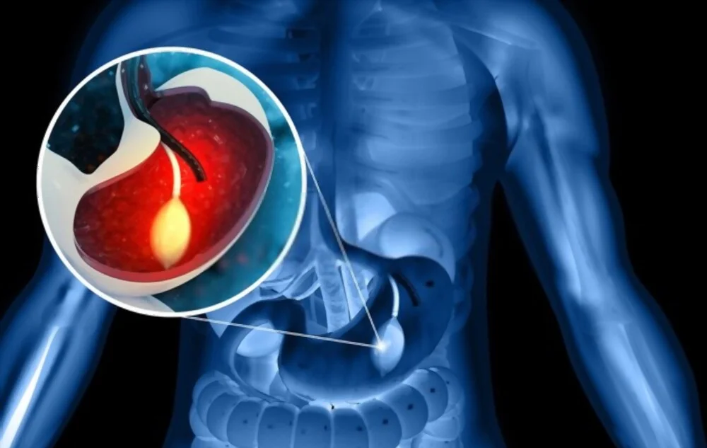 Les avantages et les inconvénients des ballons gastriques