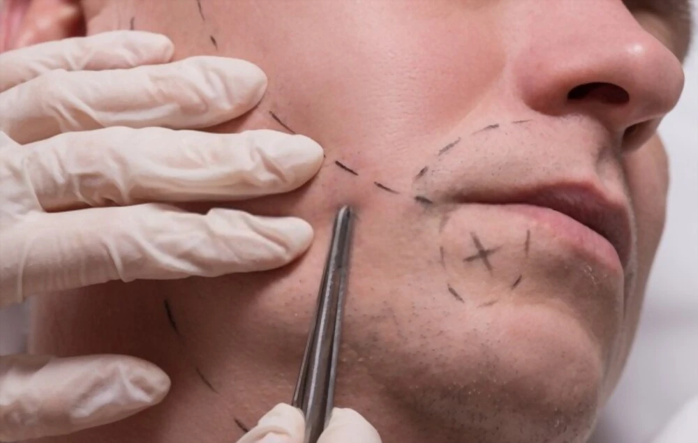 Résultat naturel après greffe de barbe en Tunisie avec la technique FUE, réalisée par un chirurgien spécialisé Medica Tour