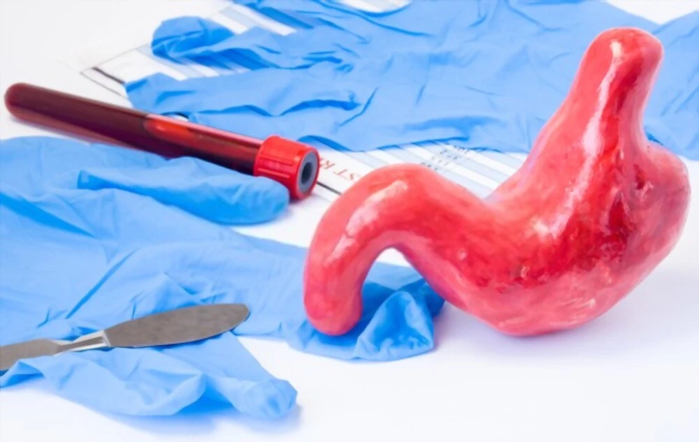 Bypass gastrique en Tunisie - Chirurgie bariatrique pour une perte de poids durable