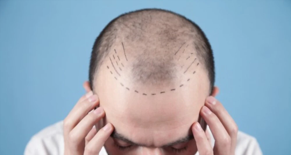 greffe cheveux en Tunisie