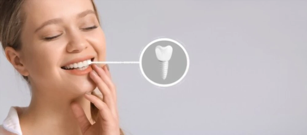 Implant dentaire en Tunisie - Qualité, confort et prix abordables