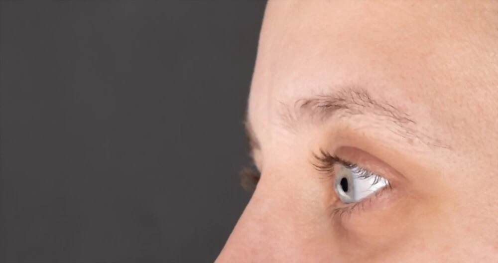 Résultat naturel après greffe de sourcils en Tunisie, arc sourcilier redessiné par technique FUE