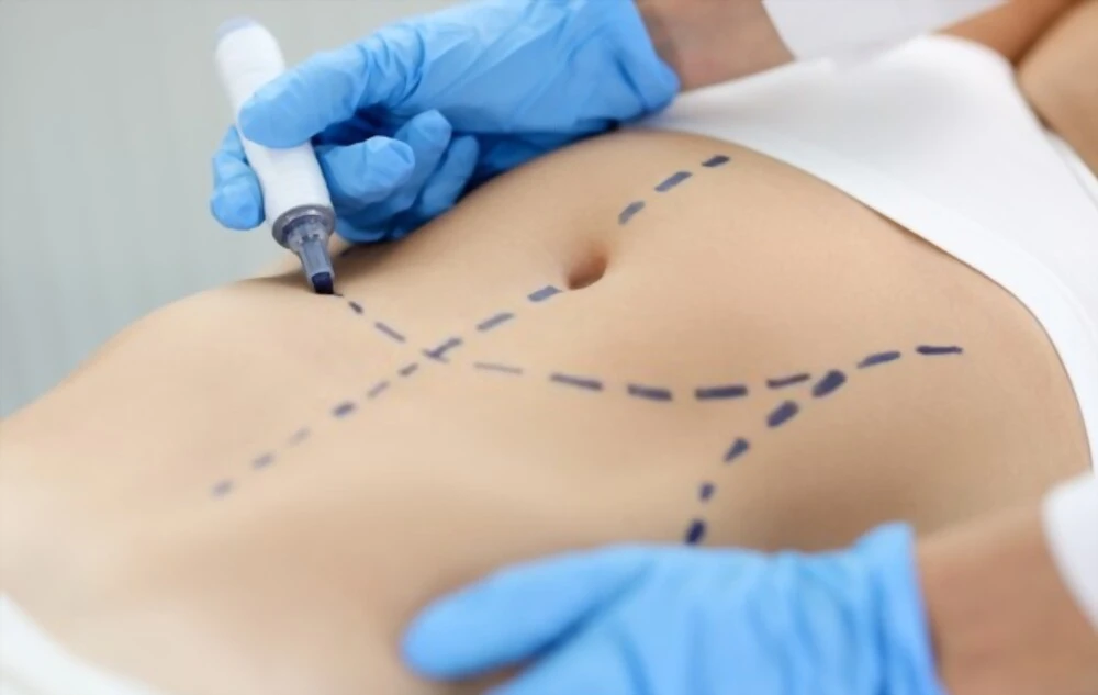 Plastie abdominale en forme de sablier ou abdominoplastie traditionnelle : Quelle est la différence ?