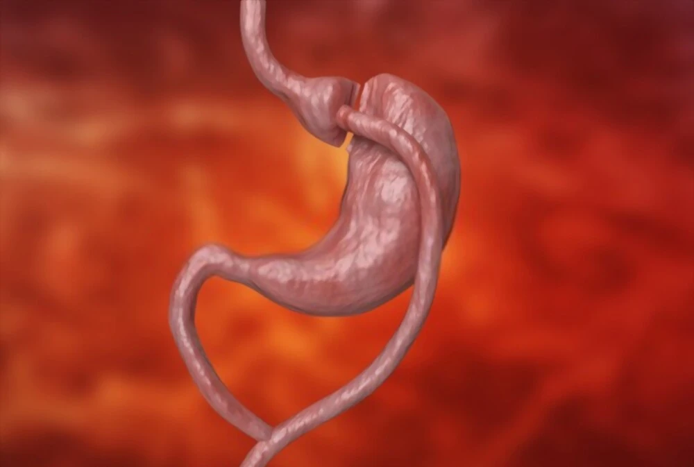 Bypass gastrique : votre nouvelle vie commence ici