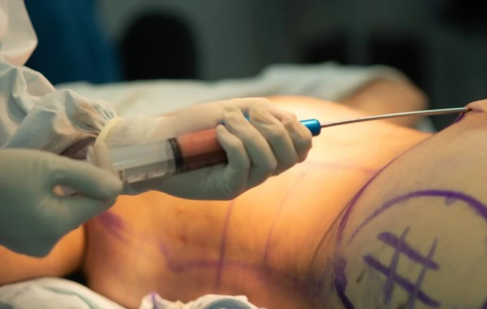 Mega liposuccion