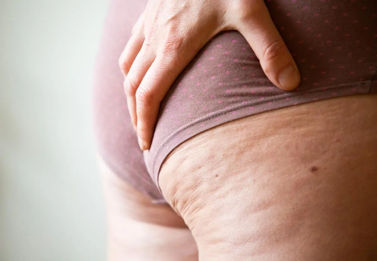 Comprendre la lipodystrophie(lipoedème) : symptômes, causes et traitements