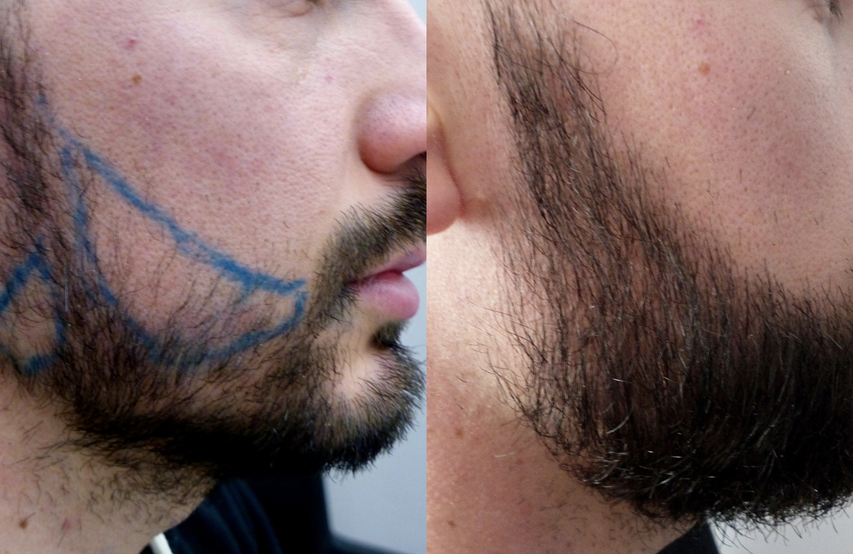 Redonner vie à votre barbe : Tout savoir sur la greffe de barbe en Tunisie