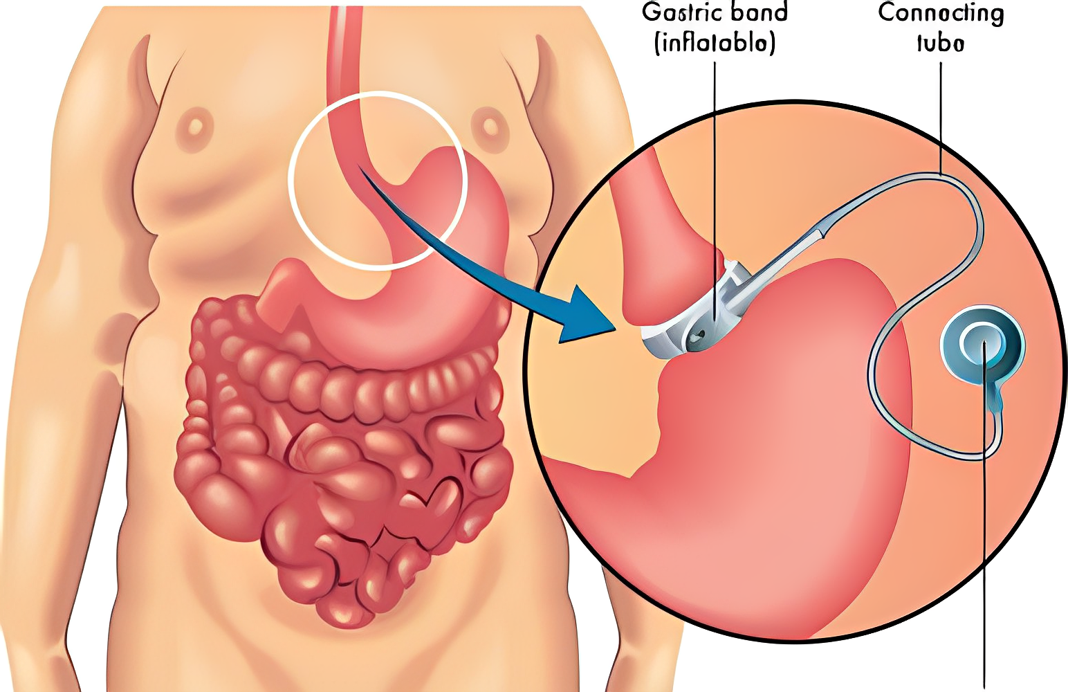 L’anneau gastrique : une solution durable contre l’obésité ?
