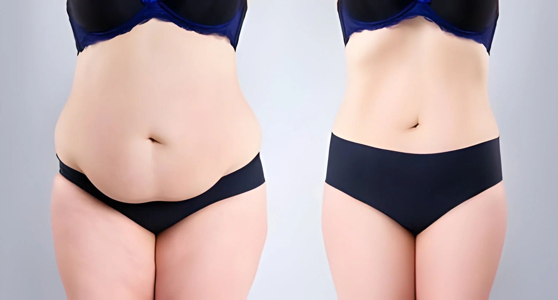 Lifting du Dos : Une Intervention Innovante pour Raffermir la Peau Relâchée