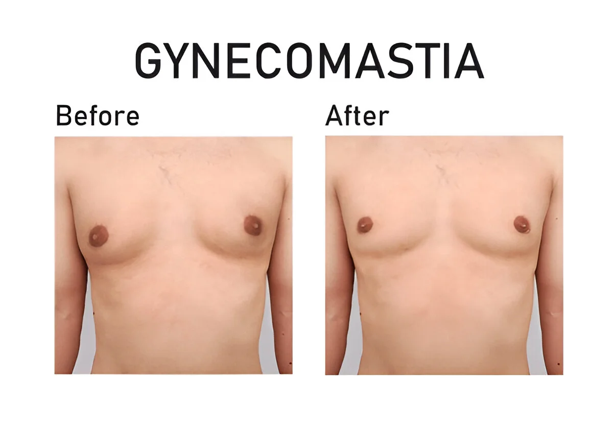 Gynecomastie en Tunisie : Traitement efficace pour une silhouette masculine harmonieuse