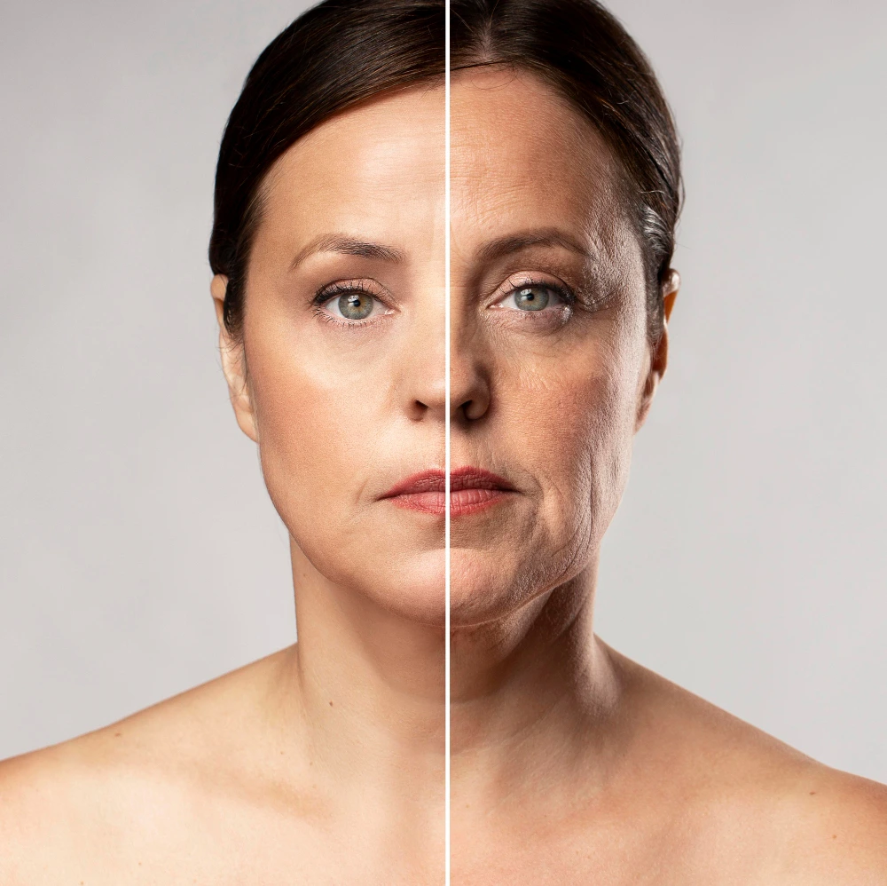 Résultat avant après d'un lifting du visage en Tunisie 