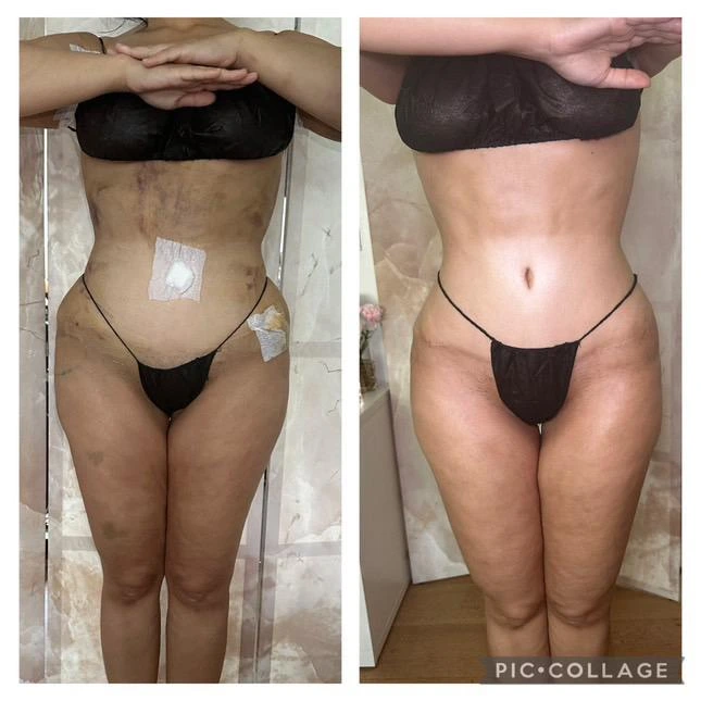 Résultat d'une liposuccion 360 degrés en Tunisie – remodelage complet du ventre et du dos