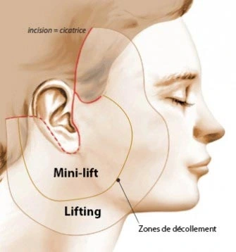 schéma illustratif d'un mini lifting visage en Tunisie