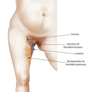 Résultat avant et après lifting des cuisses en Tunisie : cuisses raffermies et silhouette affinée