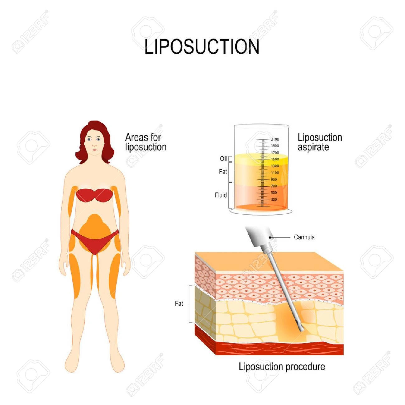 Technique de liposuccion en Tunisie pour extraire les amas graisseux résistants.