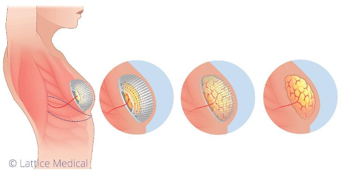 Remplacement d’implants mammaires réalisé par un chirurgien esthétique