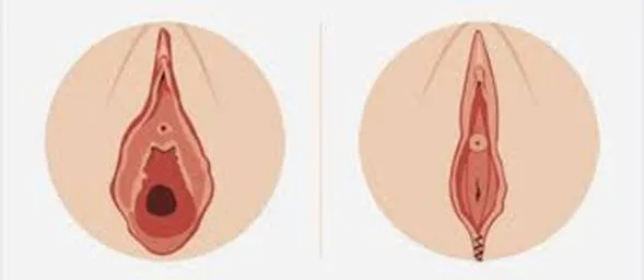 Séjour médical vaginoplastie Tunisie – intervention intime avec Medica Tour.