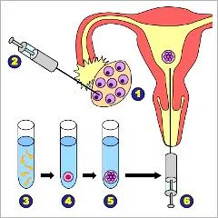 Processus de fécondation in vitro FIV pour parcours PMA en Tunisie