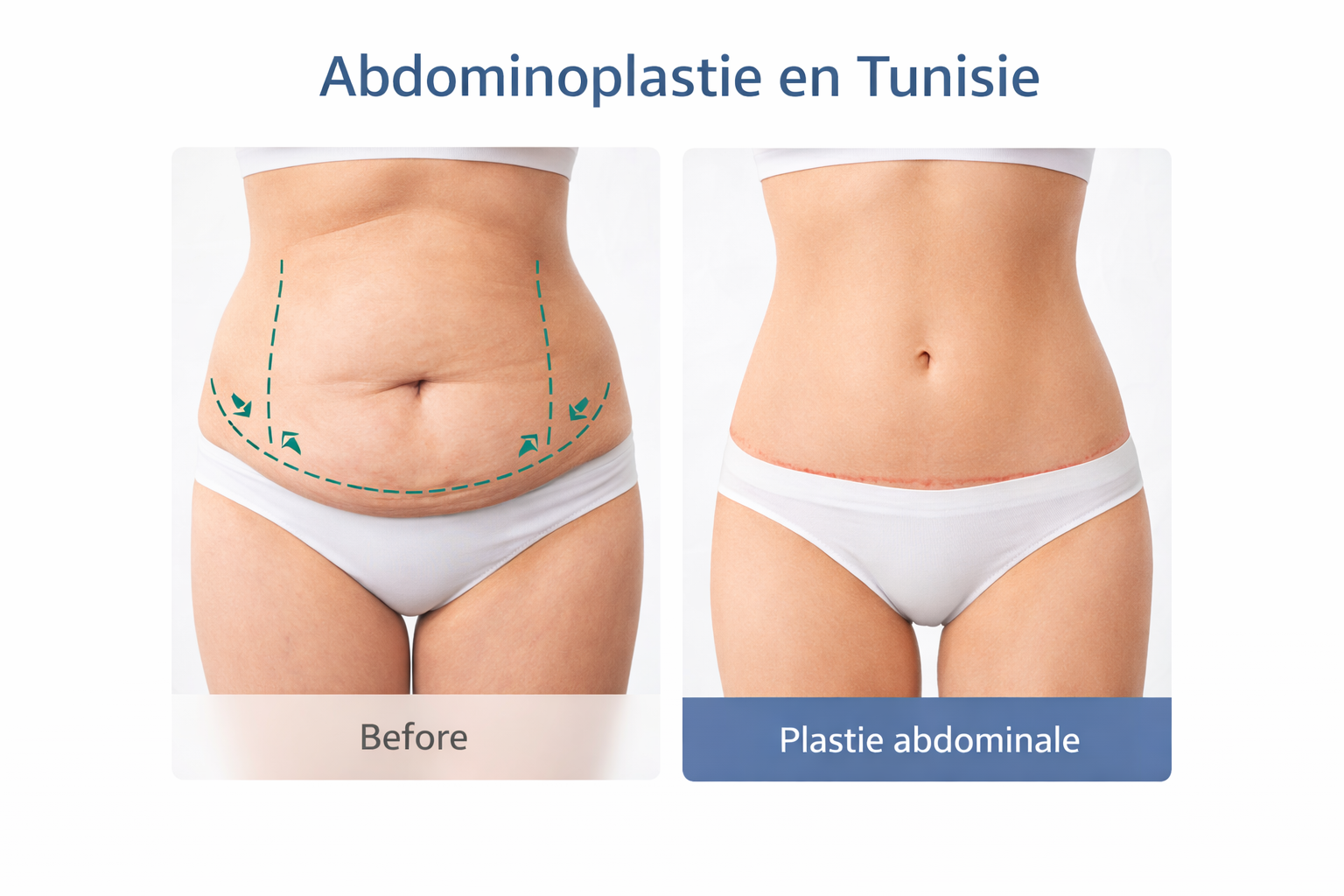 Résultat d’une abdominoplastie en Tunisie pour corriger le relâchement abdominal et obtenir un ventre plat